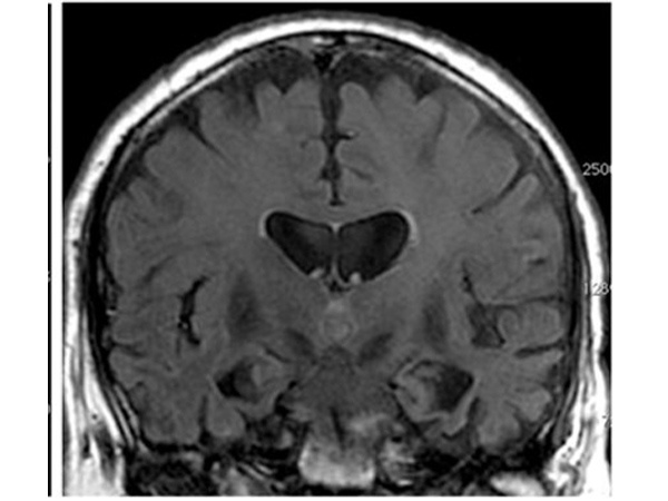 ⑤頭部MRI画像