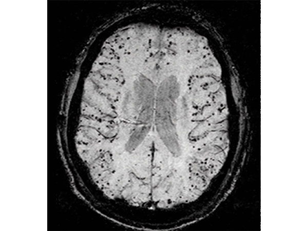 アミロイドアンギオパチーの頭部MRI画像