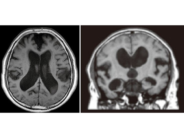 正常圧水頭症の頭部CT画像