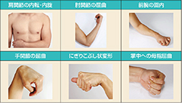 痙縮による姿勢以上の主なパターン（上肢）