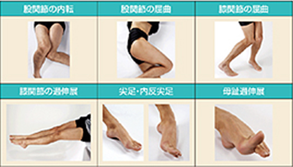 痙縮による姿勢以上の主なパターン（下肢）