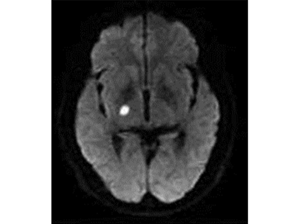 ラクナ梗塞の頭部MRI画像