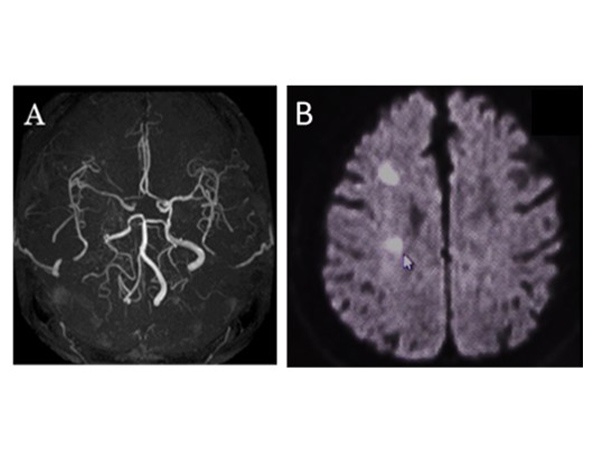 アテローム硬化性脳梗塞の（頭部MRA検査：A、頭部MRI検査：B）