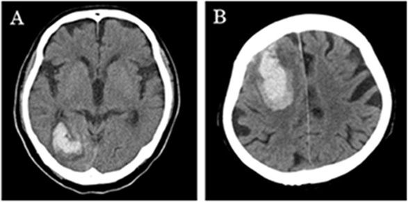 脳出血の頭部CT画像