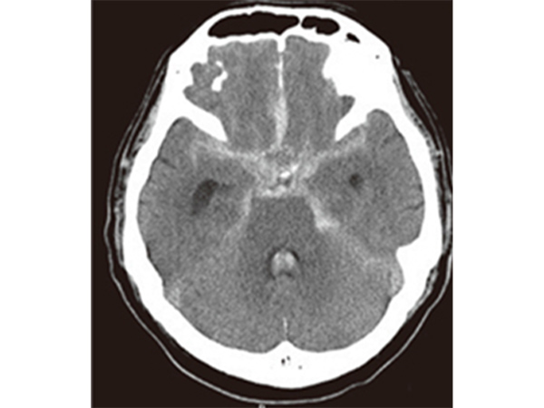 くも膜下出血の頭部CT画像