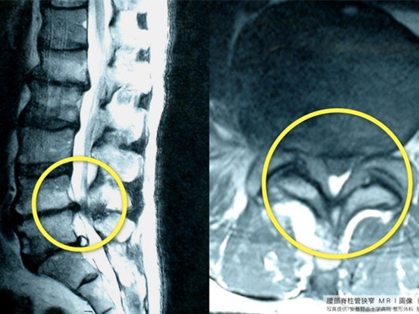 脊柱管狭窄症（頸椎症性脊髄症、腰椎脊髄症）